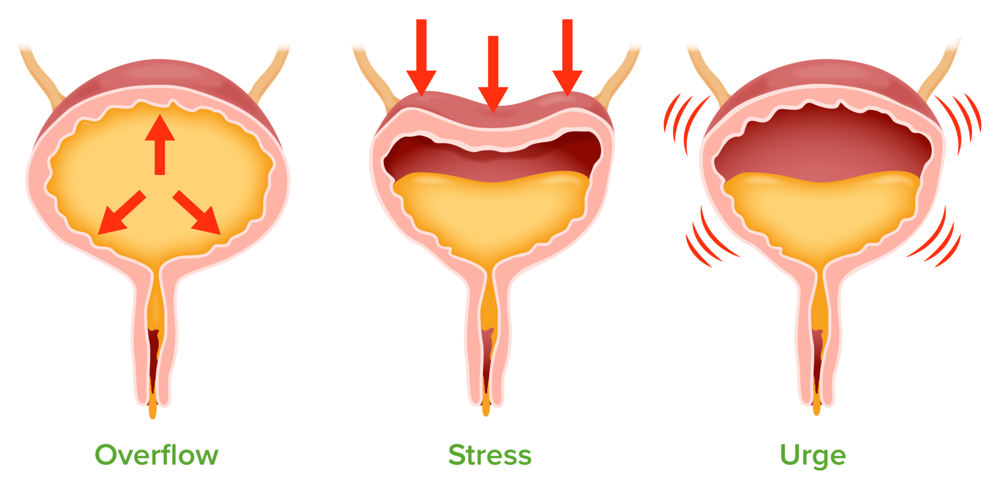 INCONTINÊNCIA URINÁRIA: O que é? Quais os tipos? Qual o tratamento ...