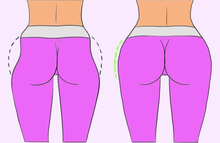 Hip Dips: Incomodam-na? Saiba quais os tratamentos! – Fisiclinic